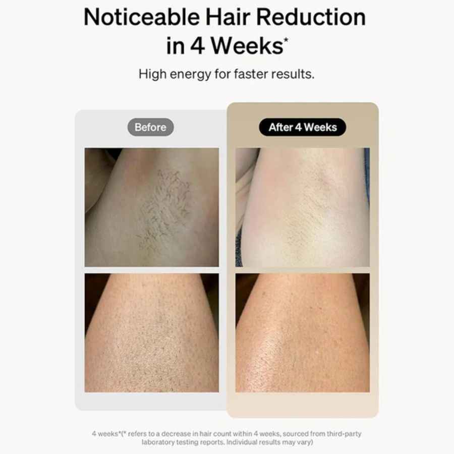 Professional Laser Epilator IPL Hair Removal Body Bikini Leg - Winima