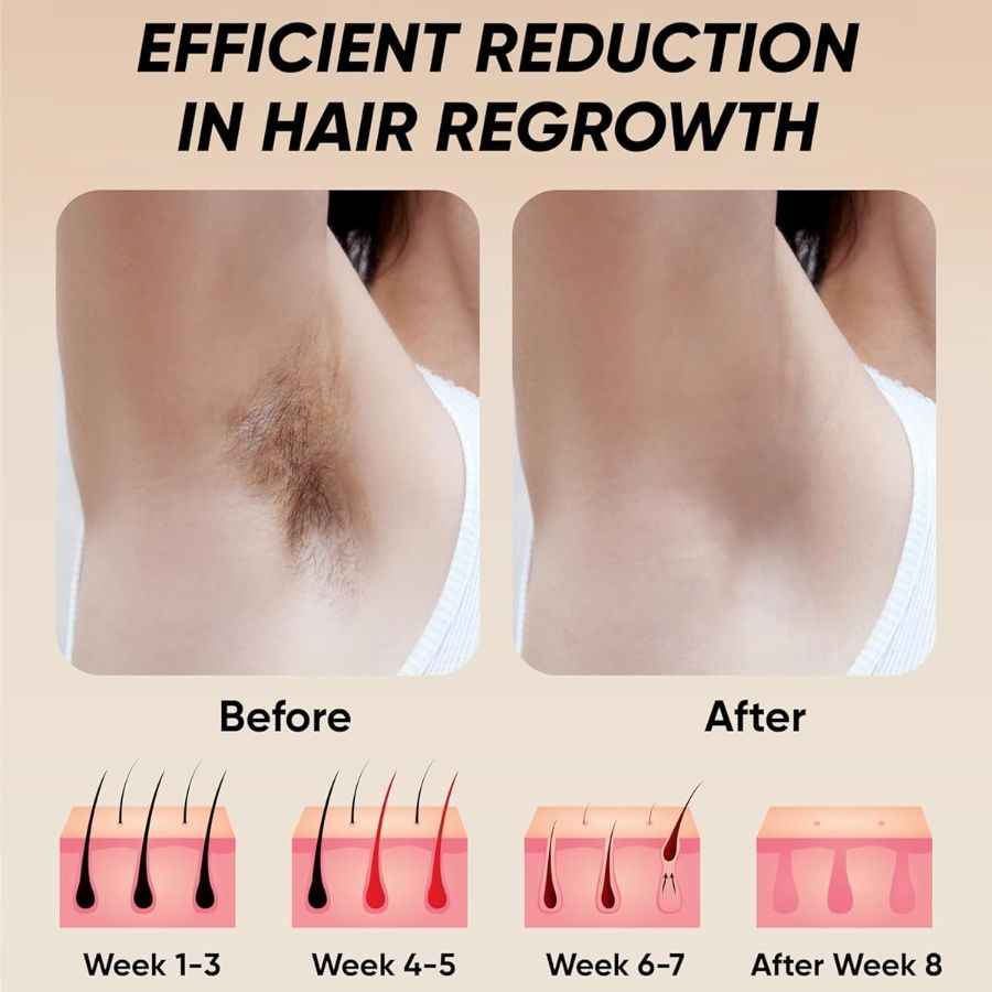 Professional Laser Epilator IPL Hair Removal Body Bikini Leg - Winima